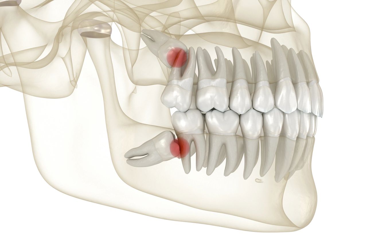 Wisdom teeth removal in Melbourne: What you need to know