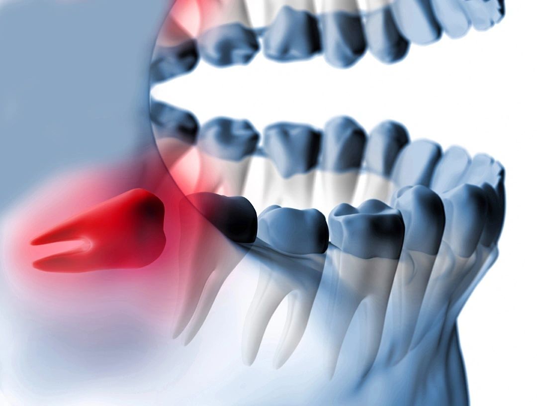 What Are the Signs of Wisdom Teeth Problems?