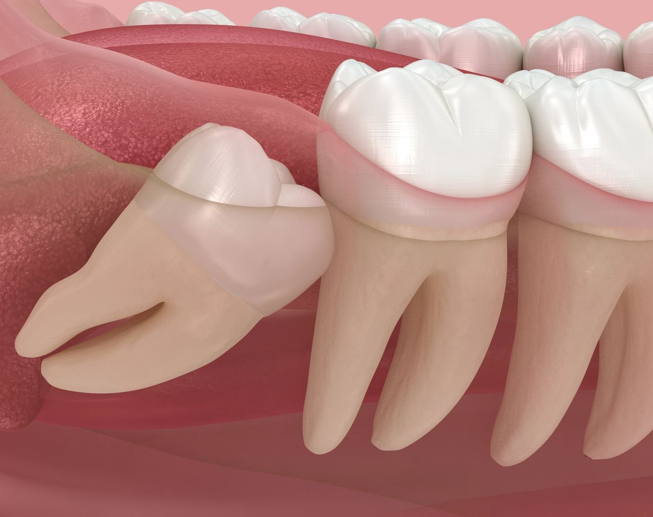 Understanding Wisdom Teeth: A Guide by TWS Wisdom Teeth Removal