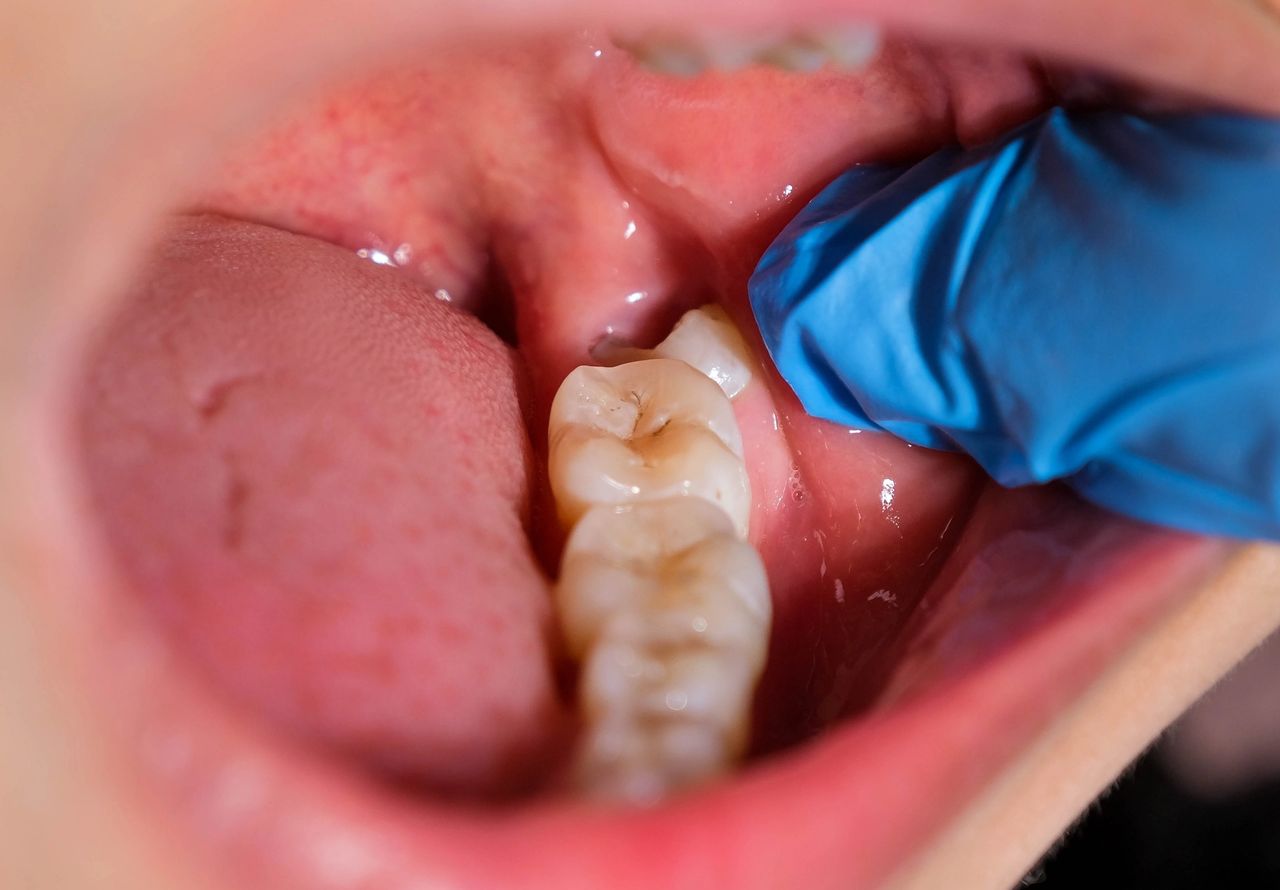 When do wisdom teeth usually come in?