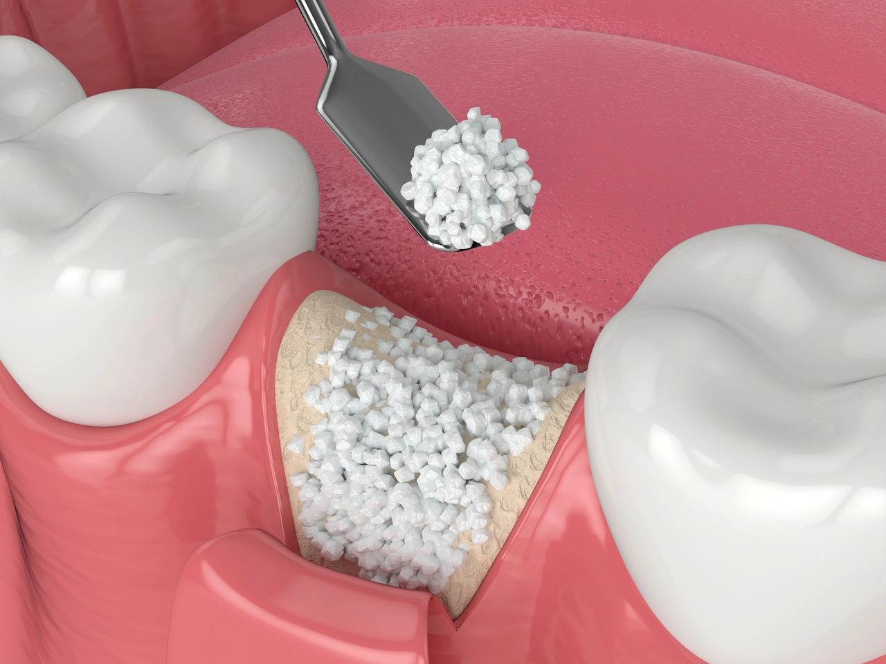 Bone Grafts - oral surgeon in Melbourne