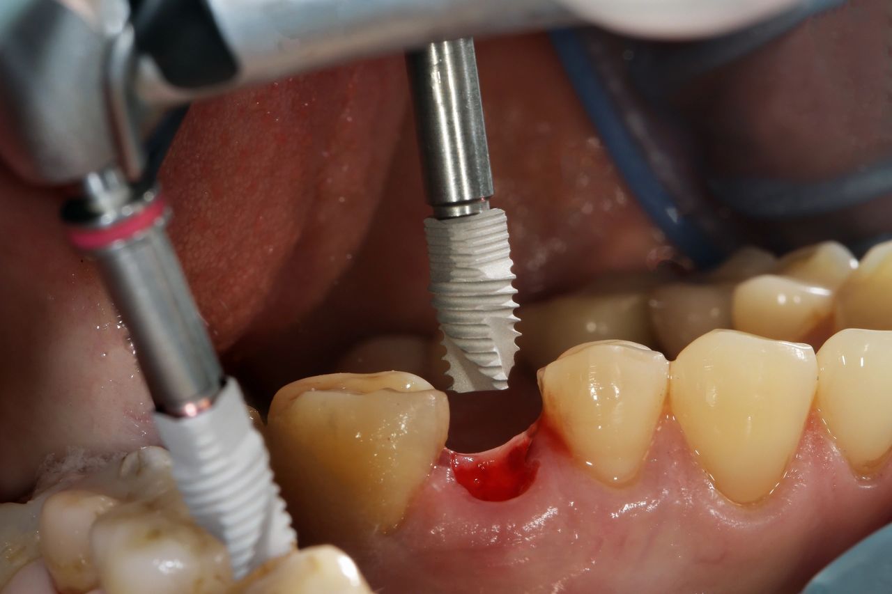 Dental Implants - oral surgeon in Melbourne