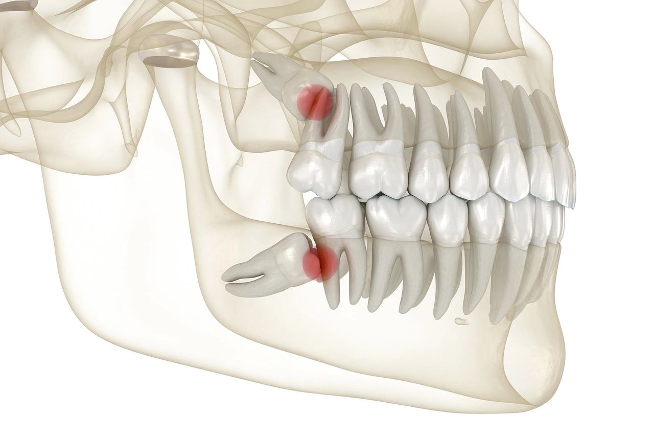 Wisdom teeth removal by an oral surgeon in Melbourne